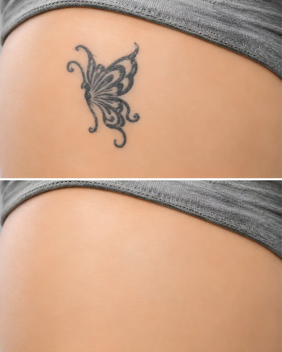 Tattoo removal at Cinch Clinics